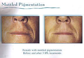 Chicago Laser Skin Rejuvenation